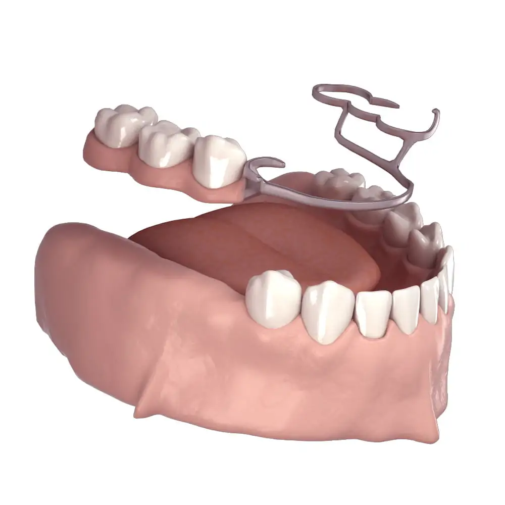 Denti parziali