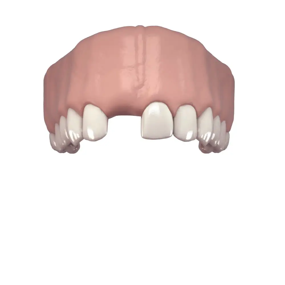 Dente singolo - Protesi fissa