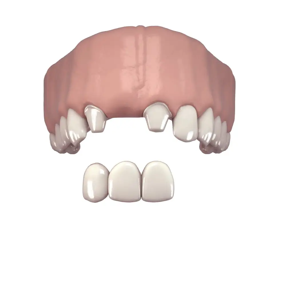 Protesi fissa denti singoli