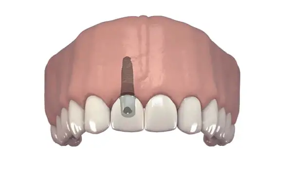 Dente singolo protesi fissa