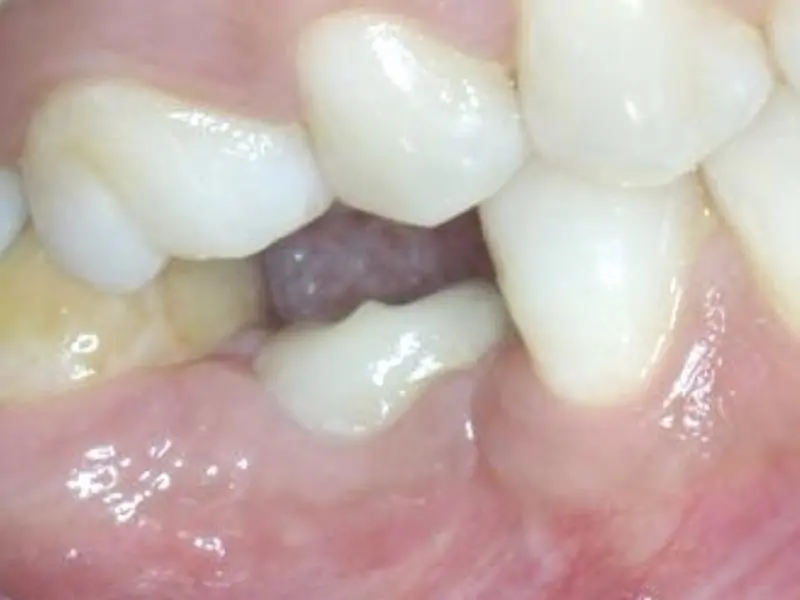 Single Implant Restoration – Prosthetic Steps 3