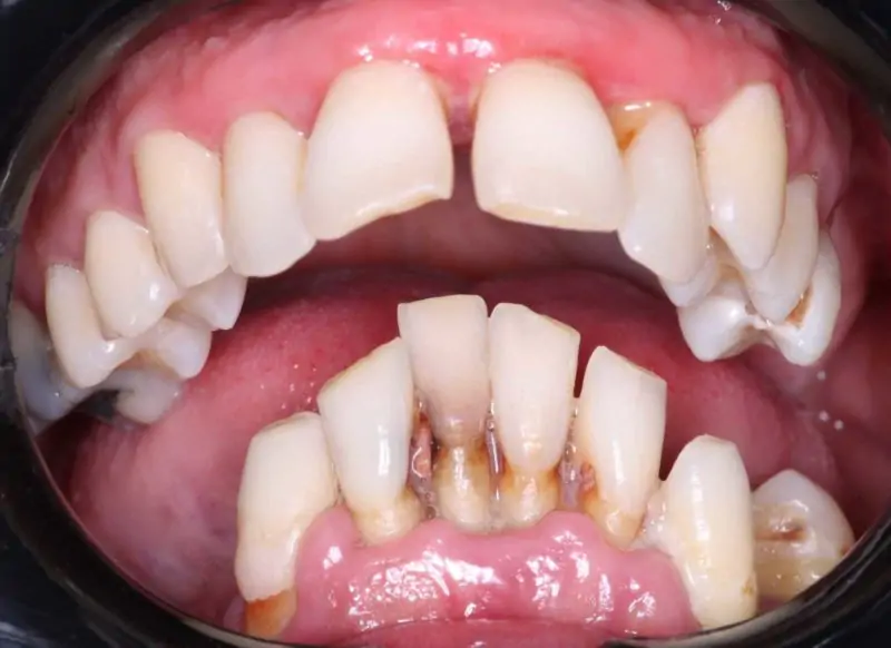 Implant Insertion With Enhanced Offset In Guided Surgery, laita balda kit offset