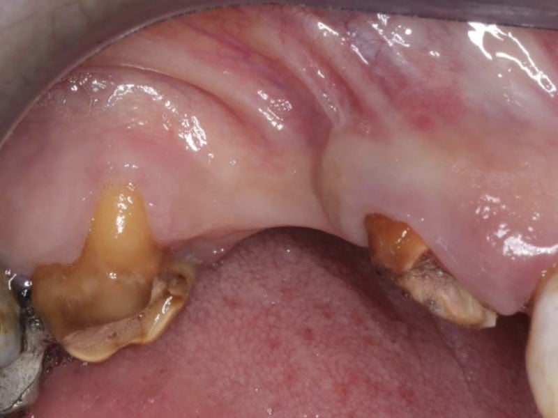 Implant Insertion Socket Type III & Pneumatized Maxillary Sinus