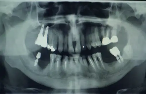 Full Arch Immediate Load Case With Osteoplasty 2 - Catalogo casi clinici
