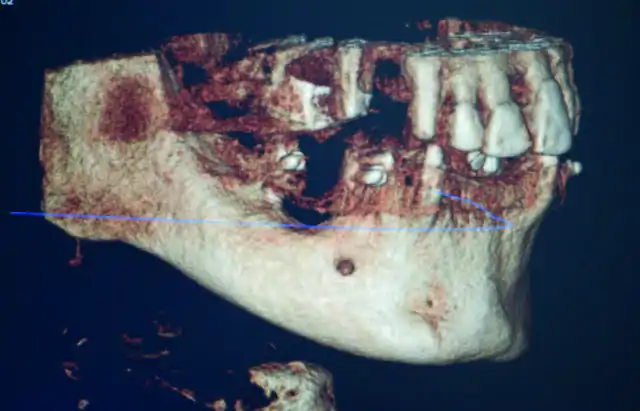 Full Arch Immediate Load Case With Osteoplasty 2 - Casi clinici