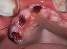 4 Implants Guided Surgery With Extractions And Immediate Loading