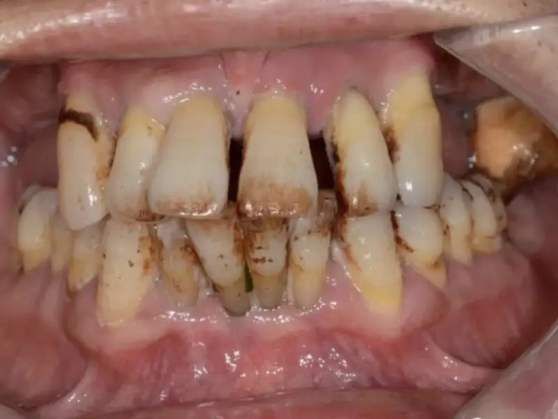 Difficult Maxilla Implant Insertion With Mua Supported Prosthesis