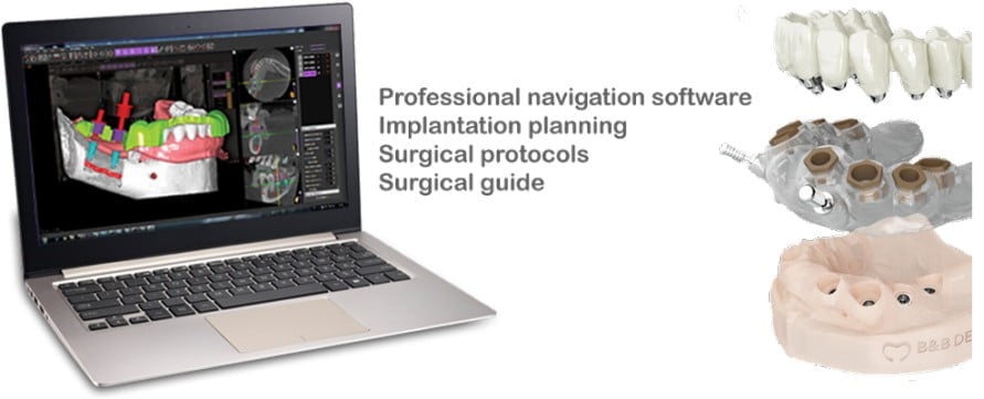 Guided Surgery Software | B&B Dental | Dental Implants