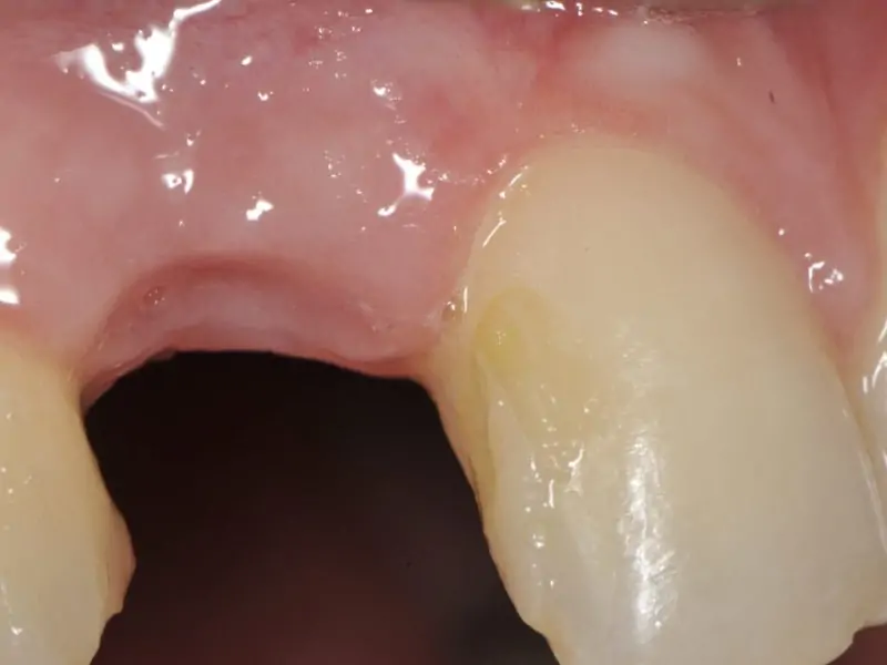 Slim Implant Insertion With Guided Surgery In Aesthetic Area 2