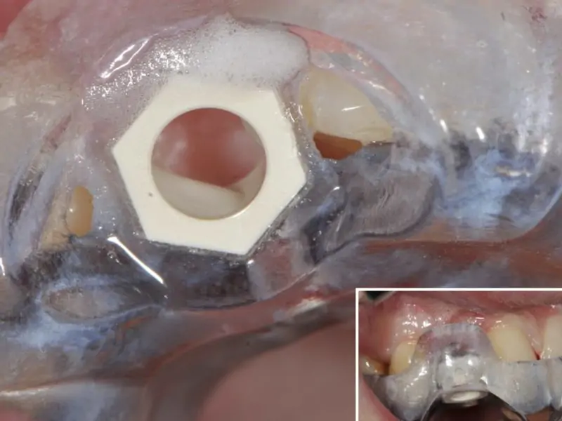 Slim Implant Insertion With Guided Surgery In Aesthetic Area
