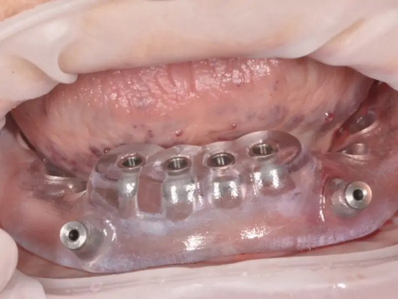 Mini Implants Guided Surgery 2