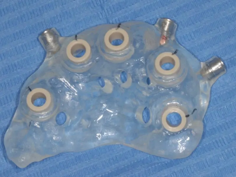 Guided Surgery Immediate Load With Use Of Previous Prosthesis