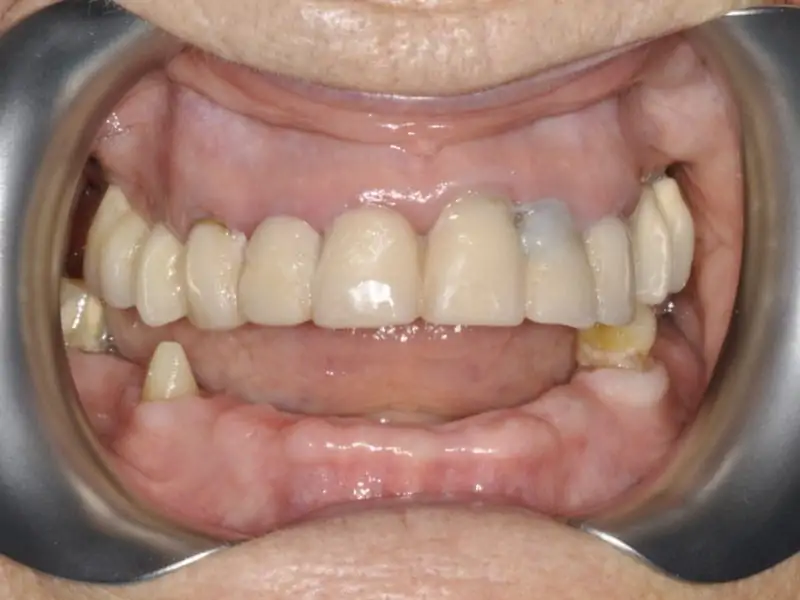 Guided Surgery With Immediate Load 4