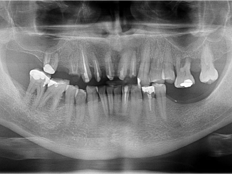 Bilateral Insertion Of Pterygoid Implants - B&B Dental