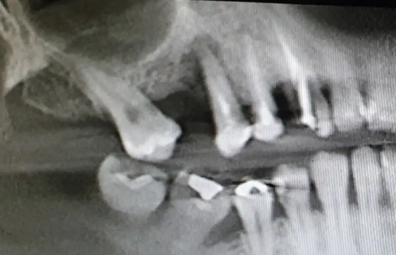 Therapeutic Treatment For Patient Maxillary Sinus Atrophy: Pterygoid Implants