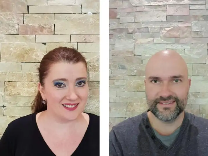 Split Crest With 3P Implants