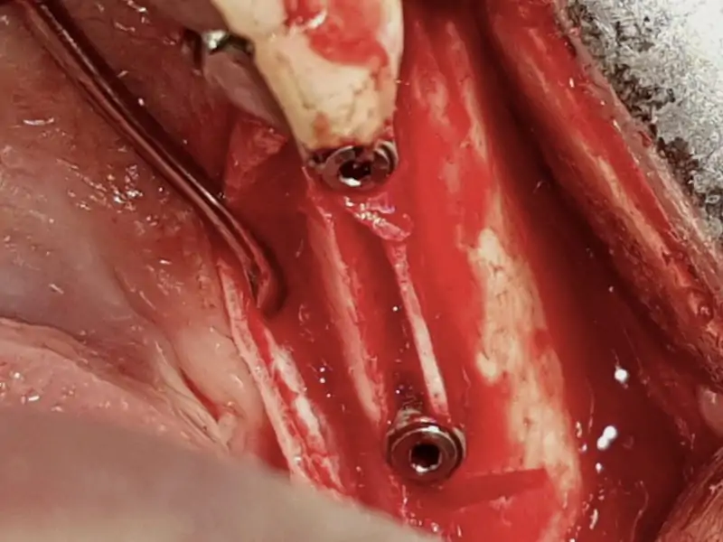 Split Crest With 3P Implants 2