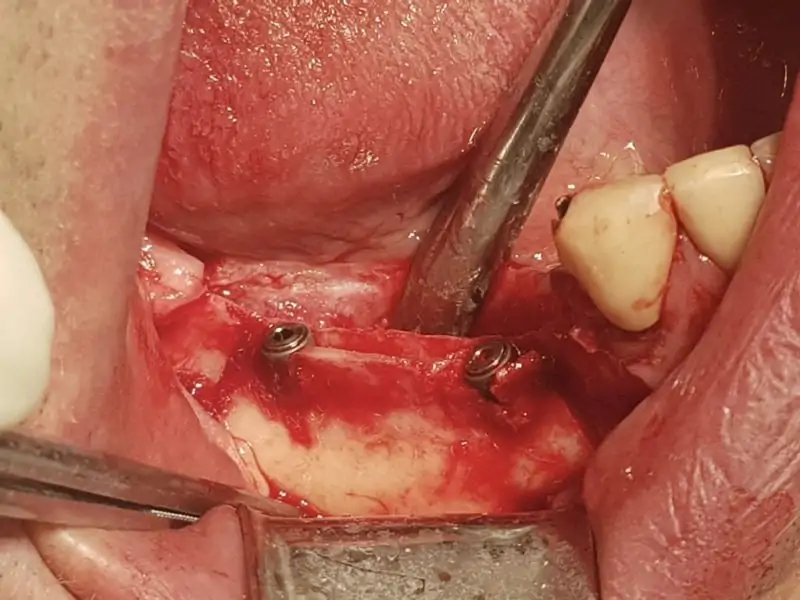 Split Crest With 3P Implants