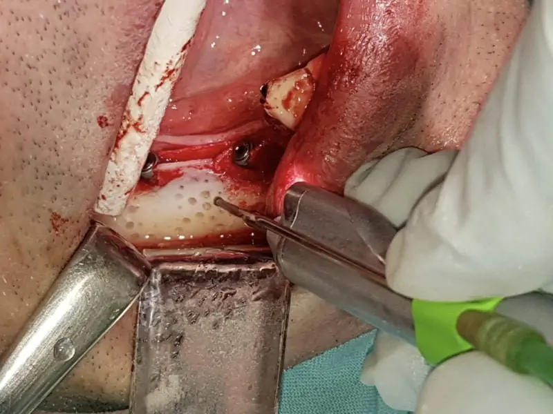 Split Crest With 3P Implants