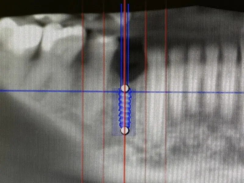 Bone Regeneration Material And Prf In Partially Exposed Implant Insertion