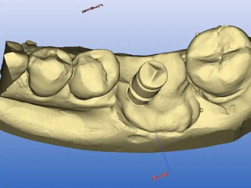 Single Tooth Restoration With Cerec System